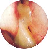 治療鼻息肉最有療效的方法